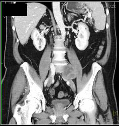 Schwannoma - CTisus CT Scan