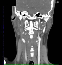 Normal Carotid Arteries and Bone Removal - CTisus CT Scan