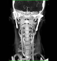 Normal Carotid Arteries and Bone Removal - CTisus CT Scan