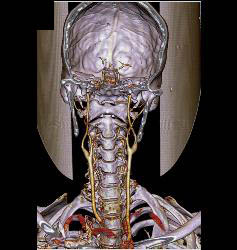 Normal Carotid Arteries and Bone Removal - CTisus CT Scan