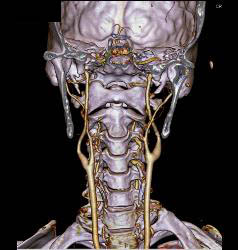 Normal Carotid Arteries and Bone Removal - CTisus CT Scan