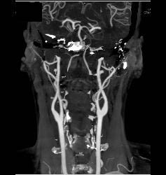 Normal Carotid Arteries and Bone Removal - CTisus CT Scan