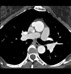 Normal Carotid Arteries and Bone Removal - CTisus CT Scan