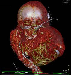 Sarcoma in Newborn - CTisus CT Scan