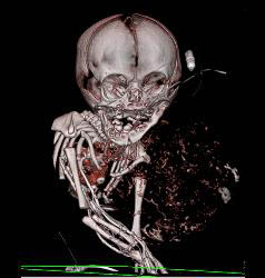 Sarcoma in Newborn - CTisus CT Scan