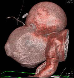 Sarcoma in Newborn - CTisus CT Scan