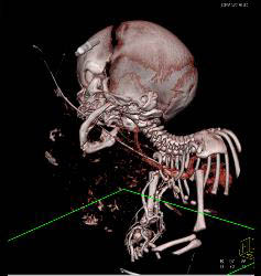 Sarcoma in Newborn - CTisus CT Scan