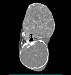 Sarcoma in Newborn - CTisus CT Scan