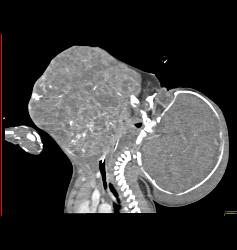 Sarcoma in Newborn - CTisus CT Scan