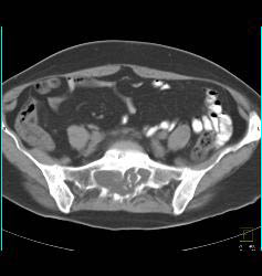 Meningocele in Marfan Syndrome With Dilated Neural Foramina - CTisus CT Scan