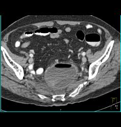 Patient Eventually Develops A Fistulae Between Meningocele and Colon Due to Diverticulitis - CTisus CT Scan