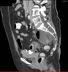 Patient Eventually Develops A Fistulae Between Meningocele and Colon Due to Diverticulitis - CTisus CT Scan