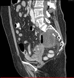 Patient Eventually Develops A Fistulae Between Meningocele and Colon Due to Diverticulitis - CTisus CT Scan