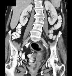 Patient Eventually Develops A Fistulae Between Meningocele and Colon Due to Diverticulitis - CTisus CT Scan