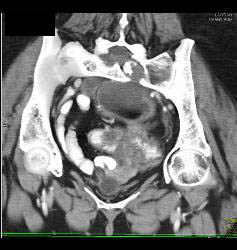 Patient Eventually Develops A Fistulae Between Meningocele and Colon Due to Diverticulitis - CTisus CT Scan