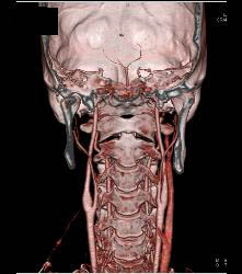 Carotid Bifurcation - CTisus CT Scan