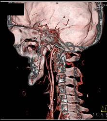 Carotid Bifurcation - CTisus CT Scan