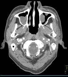 Polyps Due to Allergies - CTisus CT Scan