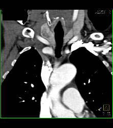 Thyroid Nodule - CTisus CT Scan