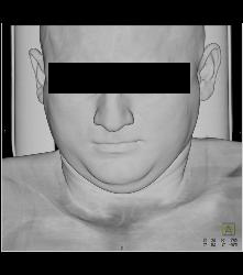 Substernal Thyroid With A Range of Renderings - CTisus CT Scan