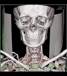 Substernal Thyroid With A Range of Renderings - CTisus CT Scan