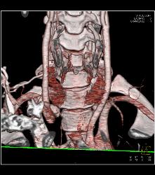 Substernal Thyroid With A Range of Renderings - CTisus CT Scan