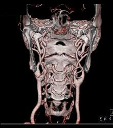 Substernal Thyroid With A Range of Renderings - CTisus CT Scan