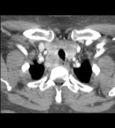 Substernal Thyroid With A Range of Renderings - CTisus CT Scan