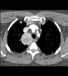 Substernal Thyroid With A Range of Renderings - CTisus CT Scan