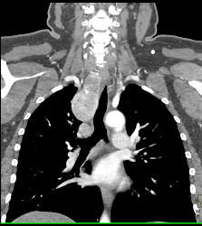 Substernal Thyroid With A Range of Renderings - CTisus CT Scan