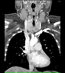 Substernal Thyroid With A Range of Renderings - CTisus CT Scan