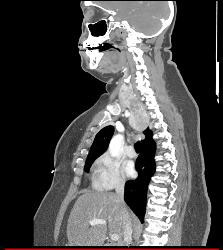 Substernal Thyroid With A Range of Renderings - CTisus CT Scan