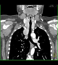 Substernal Thyroid With A Range of Renderings - CTisus CT Scan