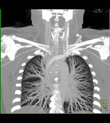 Substernal Thyroid With A Range of Renderings - CTisus CT Scan