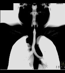 Substernal Thyroid With A Range of Renderings - CTisus CT Scan