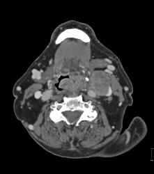 Laryngeal Cancer With Adenopathy - CTisus CT Scan