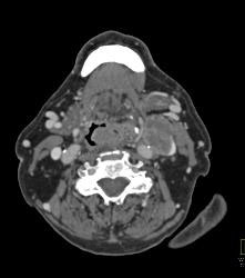 Laryngeal Cancer With Adenopathy - CTisus CT Scan