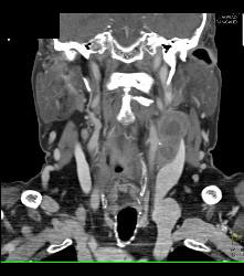 Laryngeal Cancer With Adenopathy - CTisus CT Scan