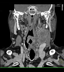 Laryngeal Cancer With Adenopathy - CTisus CT Scan