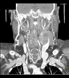 Laryngeal Cancer With Adenopathy - CTisus CT Scan