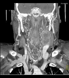 Laryngeal Cancer With Adenopathy - CTisus CT Scan