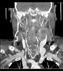 Laryngeal Cancer With Adenopathy - CTisus CT Scan