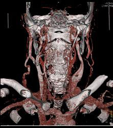 Laryngeal Cancer With Adenopathy - CTisus CT Scan