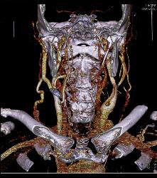 Laryngeal Cancer With Adenopathy - CTisus CT Scan