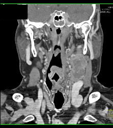 Laryngeal Cancer With Adenopathy - CTisus CT Scan