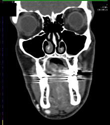 Multiple Views of An Arteriovenous Malformation (AVM) At the Angle of the Mandible - CTisus CT Scan