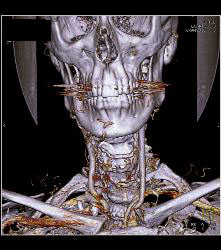 Multiple Views of An Arteriovenous Malformation (AVM) At the Angle of the Mandible - CTisus CT Scan