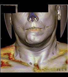 Multiple Views of An Arteriovenous Malformation (AVM) At the Angle of the Mandible - CTisus CT Scan