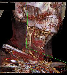 Multiple Views of An Arteriovenous Malformation (AVM) At the Angle of the Mandible - CTisus CT Scan