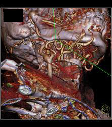 Multiple Views of An Arteriovenous Malformation (AVM) At the Angle of the Mandible - CTisus CT Scan